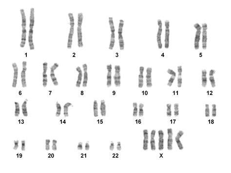 Detailed Analysis Of X Chromosome Inactivation In A 49xxxxx Pentasomy