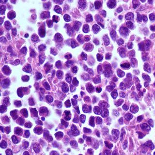 (PDF) Nevoid melanoma of the vagina: Report of one case ...