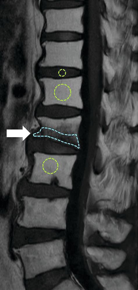 Differentiation Of Acute Osteoporotic And Malignant Vertebral Fractures
