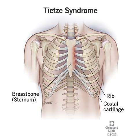 Tietzes Syndrome Casefile Reveals A Puzzling Chest Pain Condition My Xxx Hot Girl