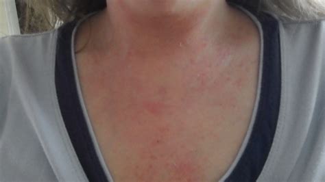 Topical Steroid Withdrawal June 2012