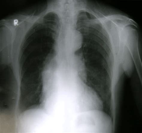 Chest X Ray Shows Prominent Aortic Knob Arrow And Mediastinal