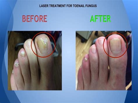 Laser Treatment For Toenail Fungus Before And After Photos