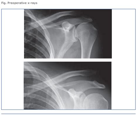Shoulder And Elbow Surgery Shoulder Separation Or Collar Bone