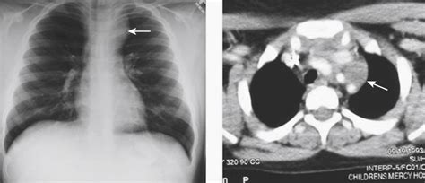 Thoracoscopic Biopsy And Resection Of A Mediastinal Mass Abdominal Key