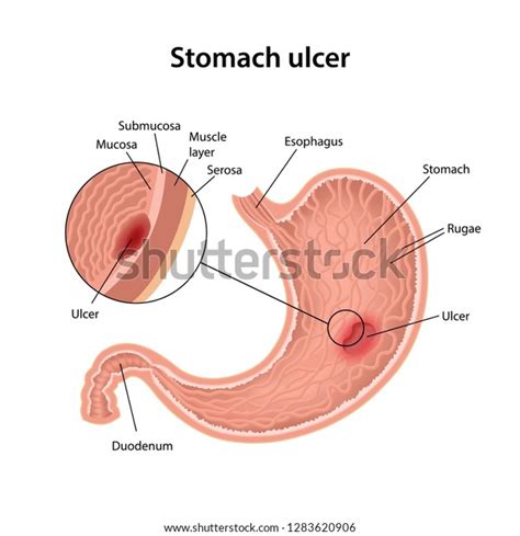 Stomach Ulcer Anatomical Vector Illustration Stomach Stock Vector Royalty Free 1283620906