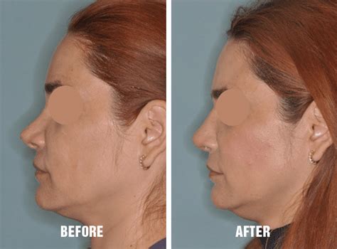 Repairing The Scooped Nose Dr Anthony Bared Md Facial Plastic