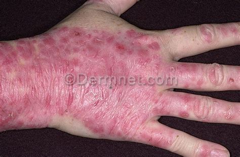 Psoriasis Of The Hand Dorothee Padraig South West Skin Health Care