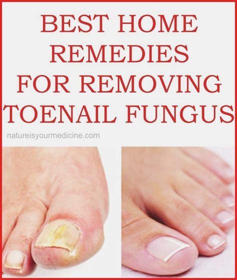 Best Home Remedies For Removing Toenail Fungus Nailfunguscurefinger
