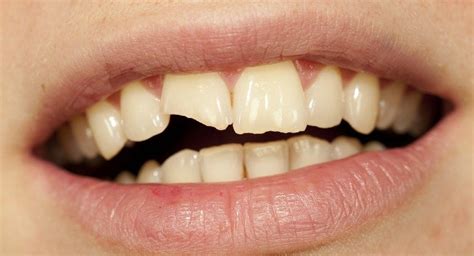 Tooth Repair Leederville Dental Perths Most Experienced Sedation