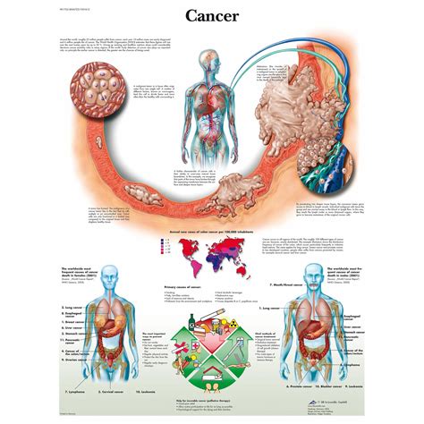 Cancer Diagram Anatomy System Human Body Anatomy Diagram And Chart My Xxx Hot Girl