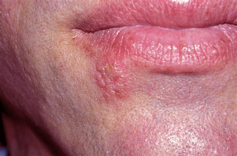 Hsv Lesions Herpes Simplex Virus Type 1 Picture Image On Medicinenet