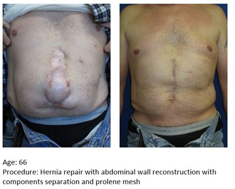 Abdominal Wall Reconstruction Uf Health Plastic Surgery And