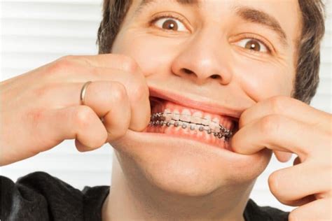 How To Handle An Orthodontic Emergency Orthodontic Associates