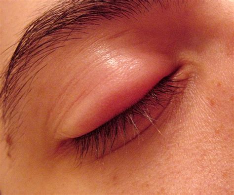 Swollen Eyelid Symptoms Treatment Pictures Causes