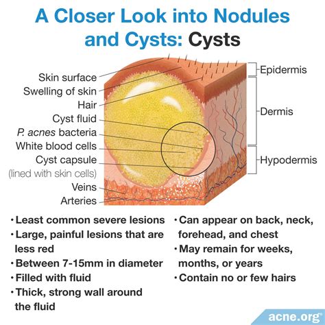 Cystic Acne On The Body