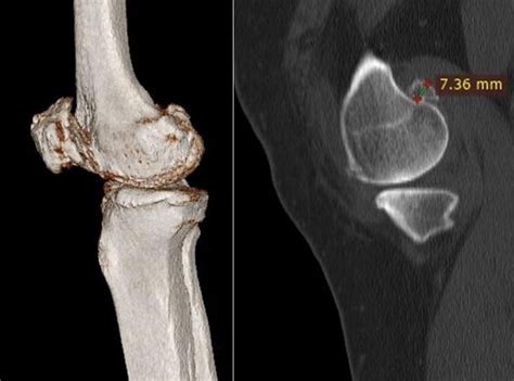 Effects Of Posterior Condylar Osteophytes On Gap Balancing In Computer