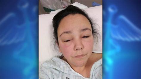 Magna Woman Suffers Severe Allergic Reaction From Hair Dye Product