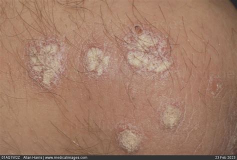 Stock Image Dermatology Mild To Moderate Psoriasis Varied And