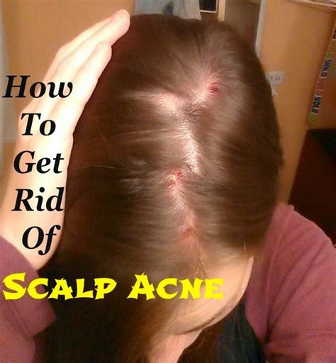 How To Get Rid Of Scalp Acne Tips Park Health Beauty Home