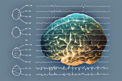 Myoclonic Atonic Seizures And Lennox Gastaut Syndrome Present With