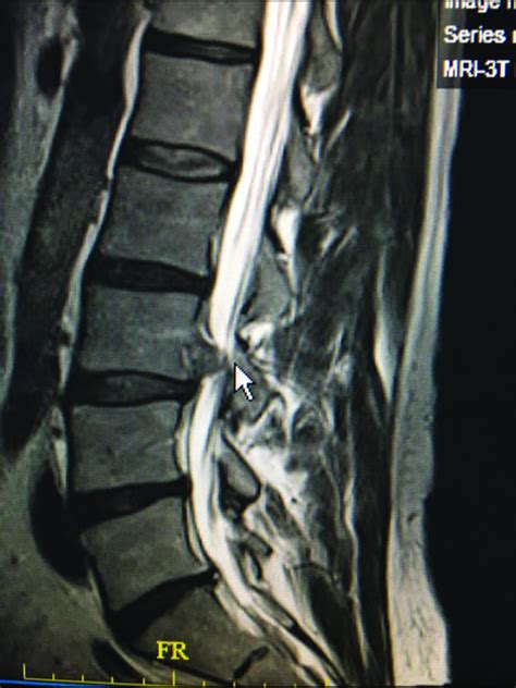 Diagnosis And Safe Excision Of Lumbar Synovial Cysts And Accompanying