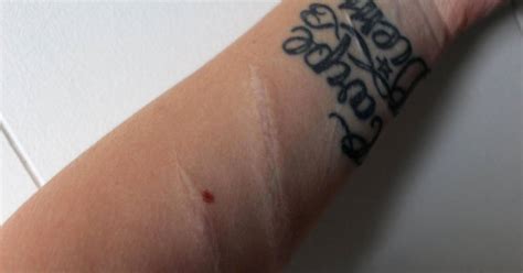woman posts scars from suicide attempt to help troubled teens
