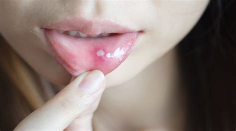 Mouth Sores Types Causes Symptoms And More HealthKart