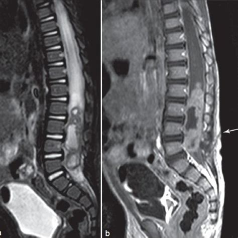 Pdf Infected Lumbar Dermoid Cyst Mimicking Intramedullary Spinal Cord