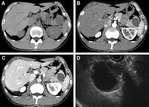 The Abdominal Computed Tomography Ct Scan Confirmed A Well Defined