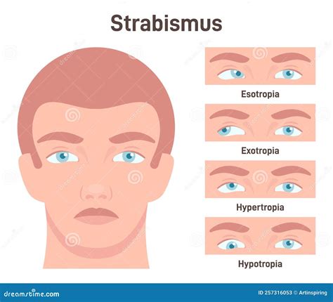 Strabismus Cross Eyed Vision Condition Types Stock Vector