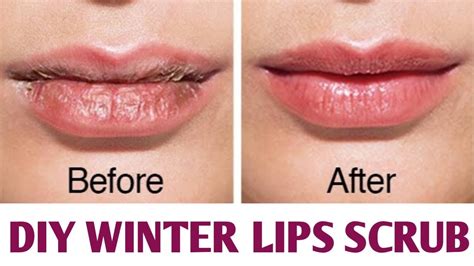 How To Help Chapped Lips In Winter Lipstutorial Org