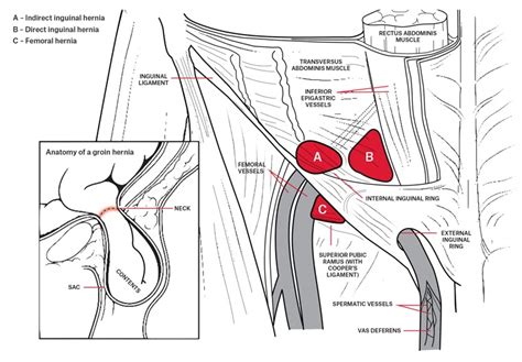 Diagram Of Groin Area Inguinal Hernia Harvard Health The Lumps May