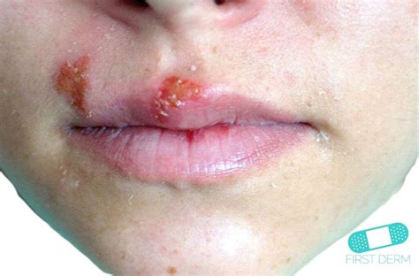 Ingrown Hair Vs Herpes Mouth It Be Fun Bloggers Photo Galery
