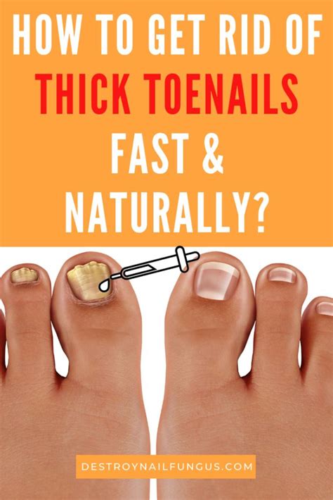 Get Rid Of Thick Toenails Quickly Thick Toenails Toe Nails Nail