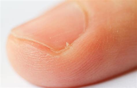 Hangnails Symptoms Causes And Treatment Dr Koop