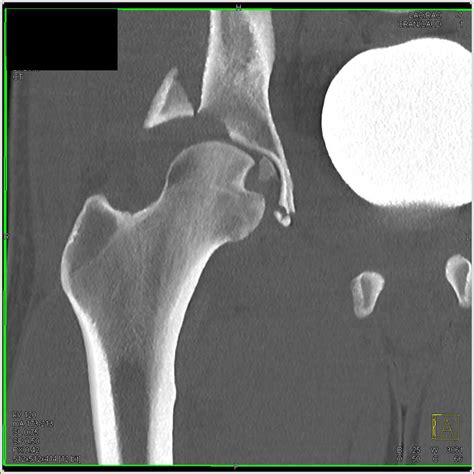 Fracture Acetabulum With Hematoma And Dislocation With Bone Fragment In