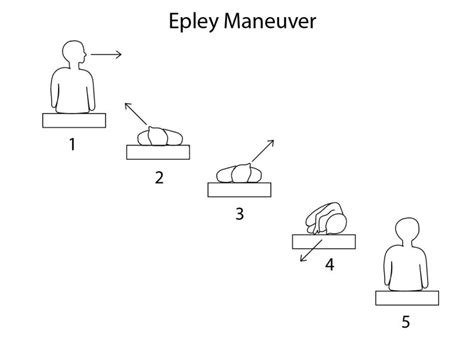 Figure Diagram Showing The Steps Of The Epley Maneuver Contributed