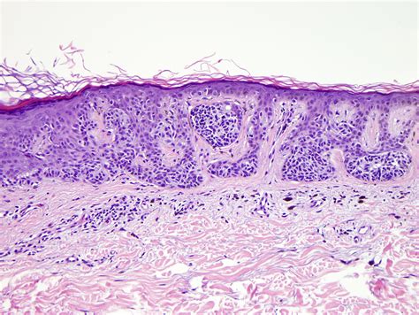 Dysplastic Nevus Histology