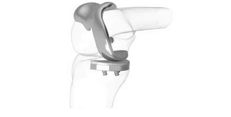 3d Printing Will Now Enable Customized Knee Replacement Surg