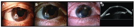 Corneal Ulcer Of A Patient With Salzmanns Nodular Degeneration Treated