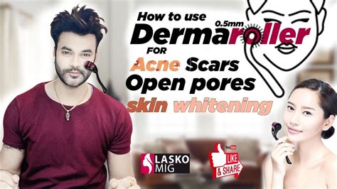 How To Use Dermaroller For Acne Scars Open Pores Skinwhitening