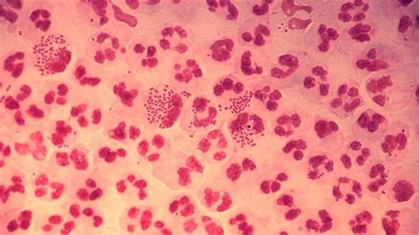 Systemic Gonococcal Infection Causes Symptoms And Diagnosis