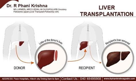 Liver Transplantation Surgery Liver Failure Healthy Liver