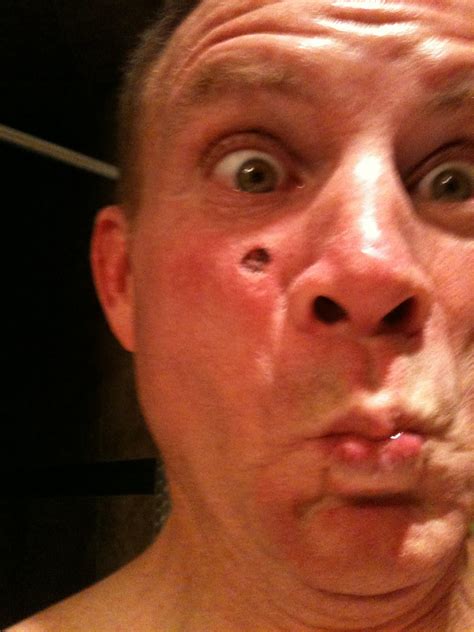 Are expected to be diagnosed with some type of the disease. Free download Red Scaly Patch On My Face programs ...