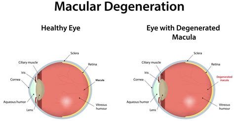 Cataract Surgery And Macular Degeneration