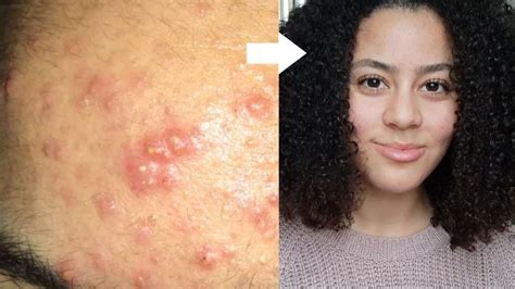I Had A Bacterial Infection My Skin Story Sarelly Youtube