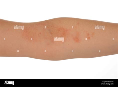 Dermatitis Eczema On The Skin Of The Womans Arm Isolated On White
