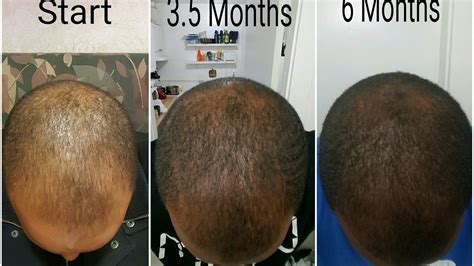 How To Grow Hair In Bald Spots Naturally Use If You Are Experiencing