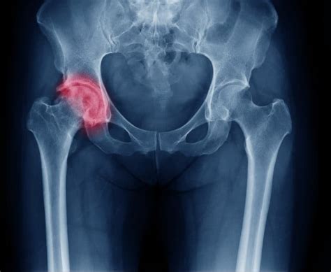 Hip Injuries From Car Accidents Aica Orthopedics